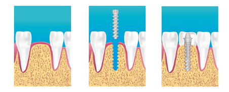 Implant dentaire à Poitiers 86000